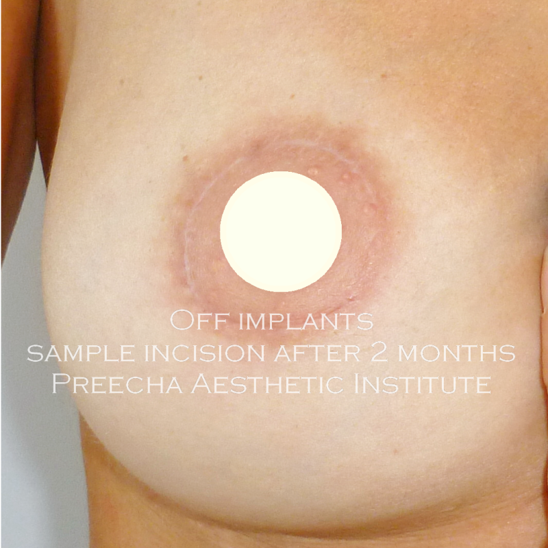 off implant removal by preecha aesthetic institute