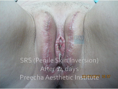 HN 6016894 Penile Skin Inversion 14 days