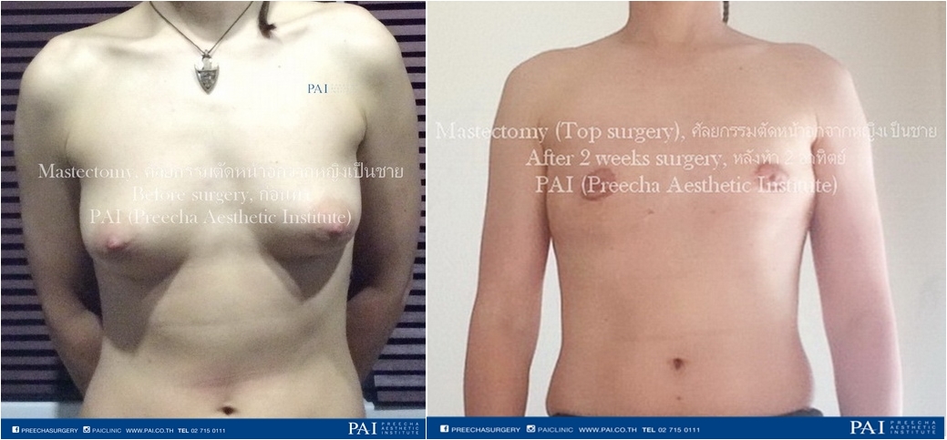 before and after keyhole incision top surgery