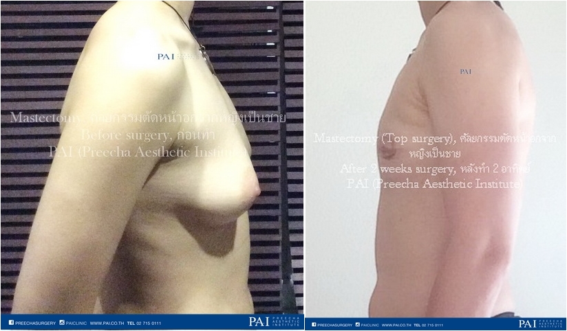 before and after two weeks keyhole incision top surgery side view