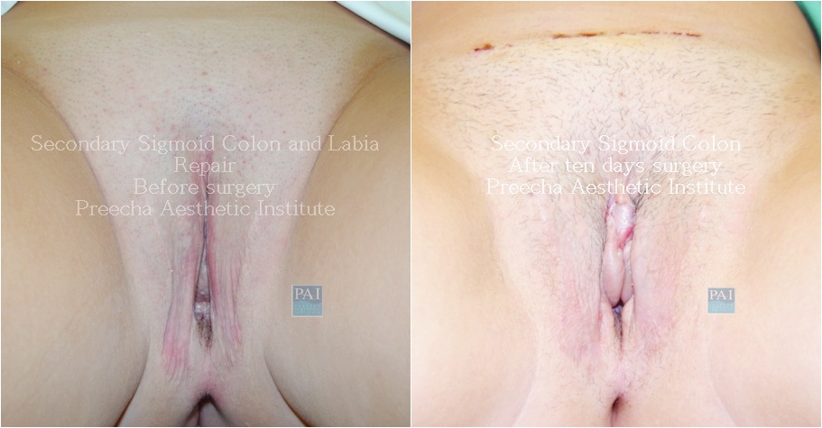 Before and after secondary sigmoid colon by preecha aesthetic institute bangkok thailand. leading sex reassignment surgery center