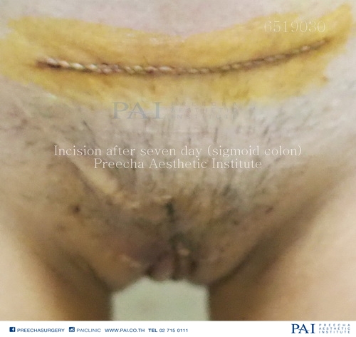 incision sigmoid colon after seven day leading sex change surgery male to female center