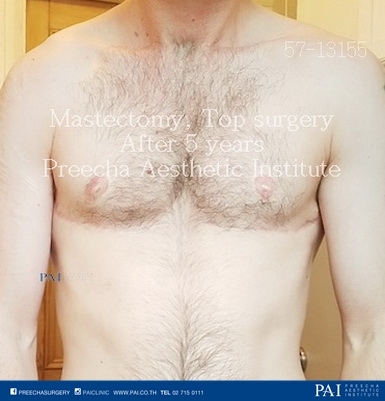 mastectomy, breast removal, top surgery ftm after surgery