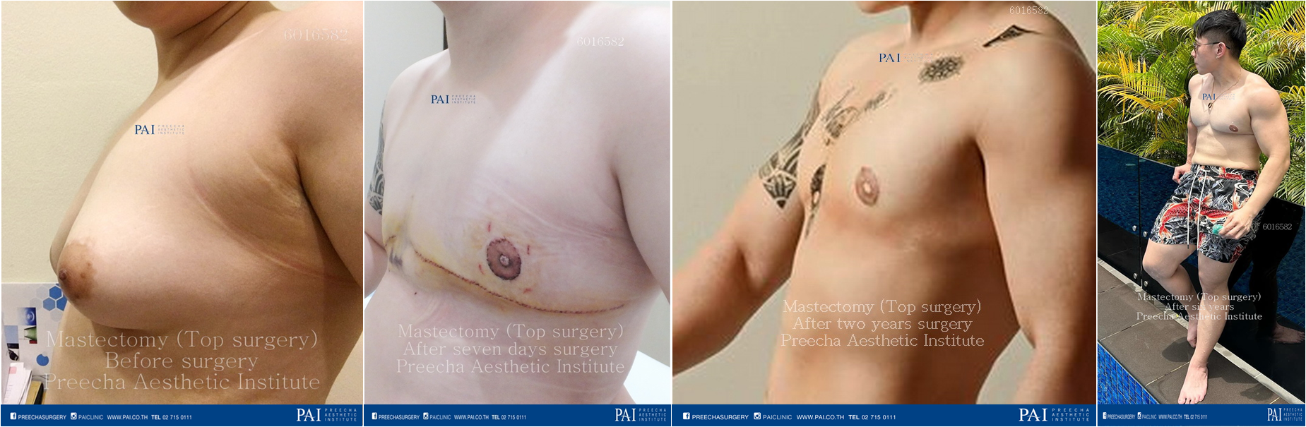 mastectomy top surgery breast removal before and after female to male breasts surgery