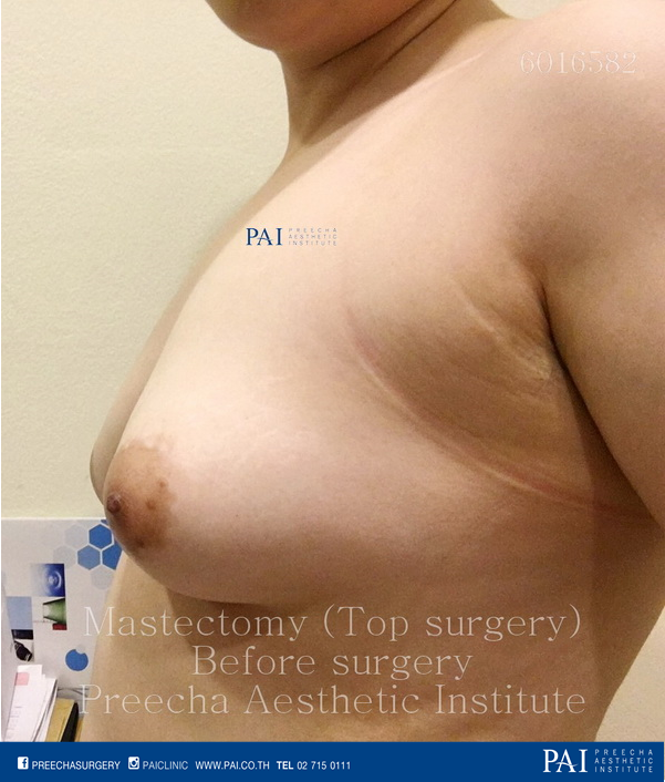 mastectomy top surgery breast removal before surgery