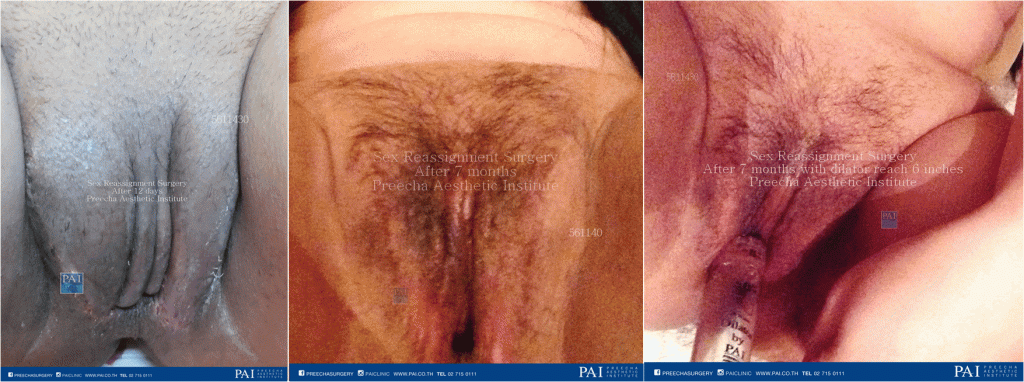 penile skin inversion male to female post op seven month dilator l preecha aesthetic institute