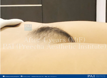 penile skin invertion mtf result l preecha aesthetic institute bangkok thailand
