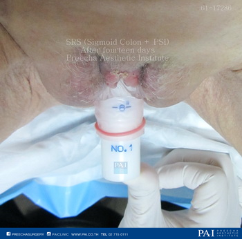 primary sigmoid colon with penile skin inversion