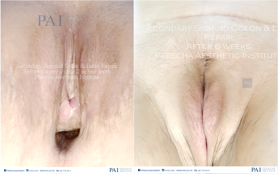 secondary sigmoid colon maletofemale before and after surgery leading m2fsurgery thailand l preecha aesthetic institute