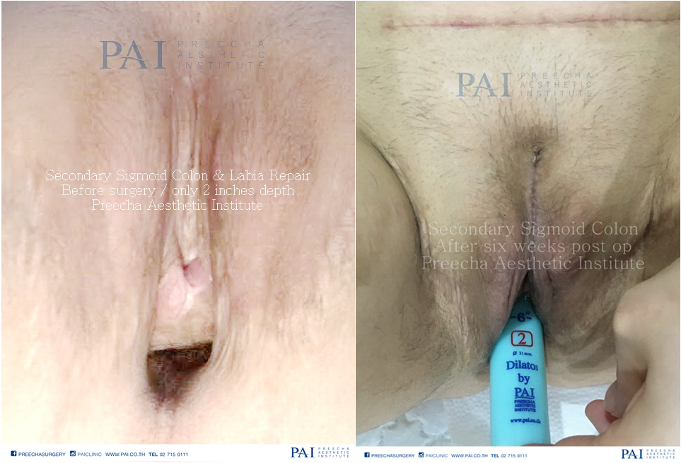 secondary sigmoid colon with labia repair maletofemale before and after surgery l preecha aesthetic institute
