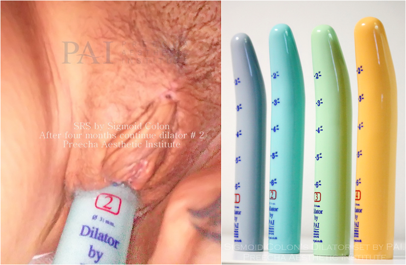 sex change mtf surgery sigmoid colon penile skin inversion by preecha aesthetic institute