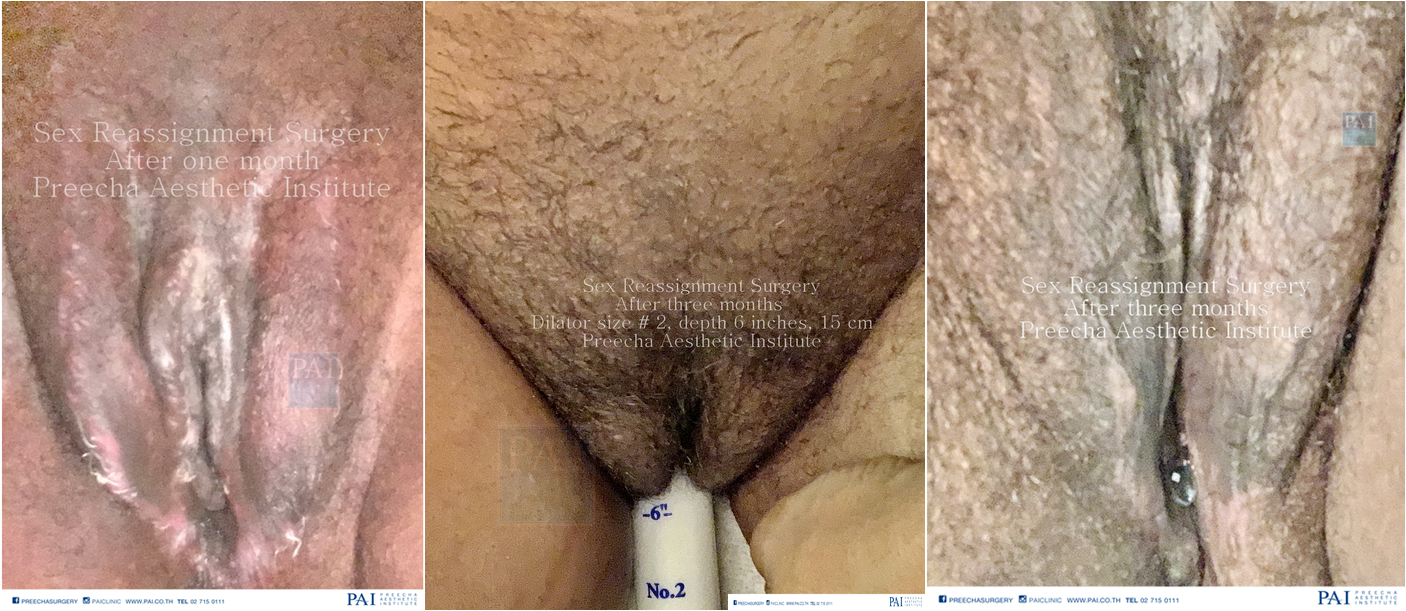 srs mtf surgery result after one and three month dilator l Preecha Aesthetic Institute PAI