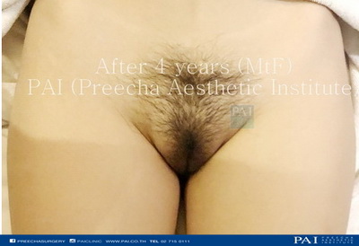 srs penile skin inversion after four years