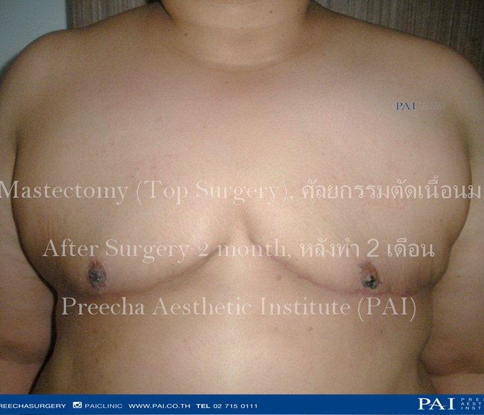 top surgery female to male FtM after 2 months l Preecha aesthetic institute