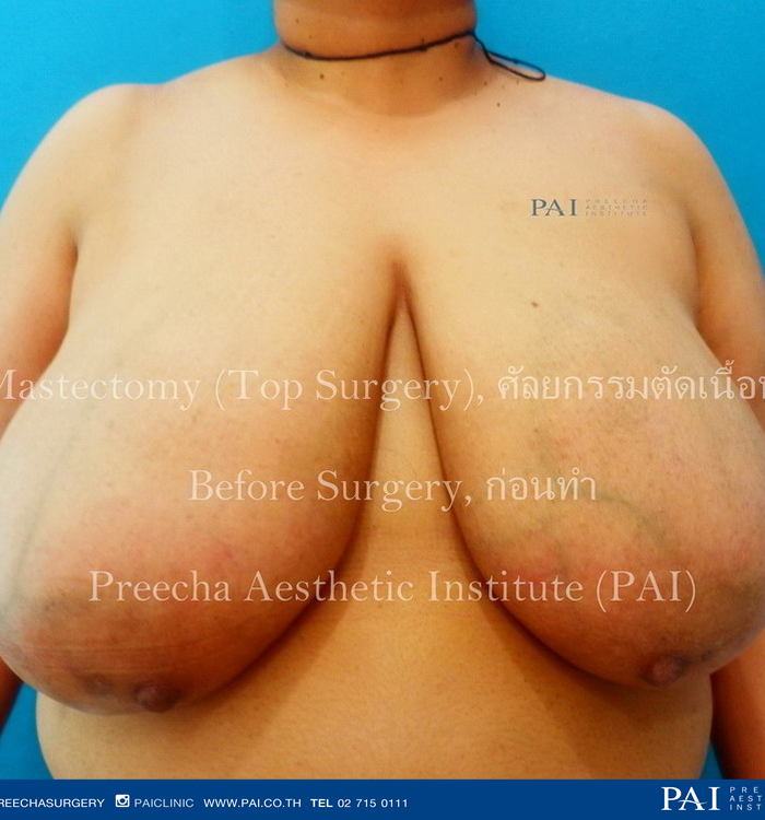 top surgery female to male FtM before surgery l Preecha aesthetic institute