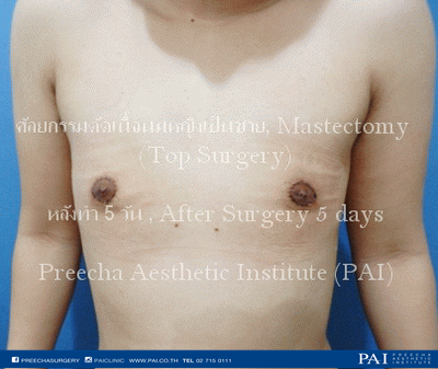 top surgery keyhole incision after five day surgery l preecha aesthetic institute