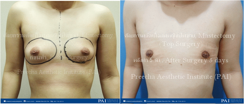 top surgery keyhole incision before and after remove incision five days surgery l preecha aesthetic institute