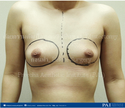 top surgery keyhole incision before surgery l preecha aesthetic institute