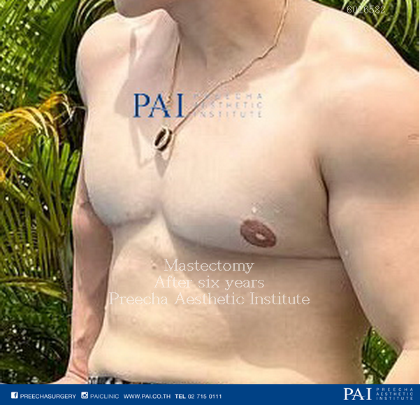top surgery mastectomy breast removal double incisions nipple grafts female to male surgery f2m surgery l preecha aesthetic institute