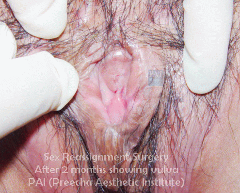 two months post op showing vulva
