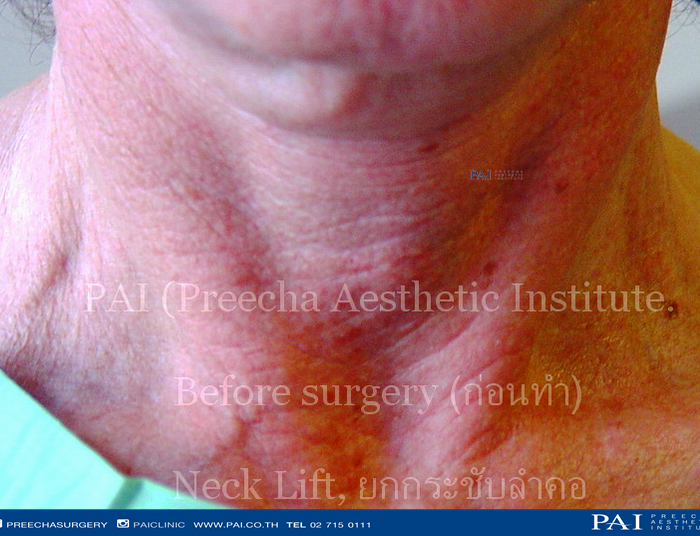 Before neck lift l preecha surgery bangkok thailand
