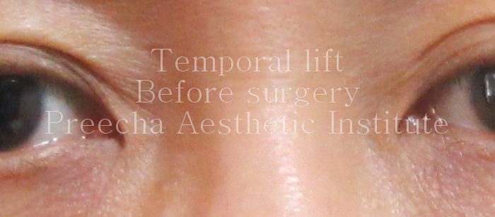 Before surgery temporal lift
