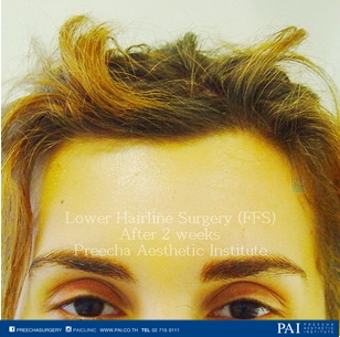 Lower Hairline Surgery facial feminization surgery (FFS) after surgery