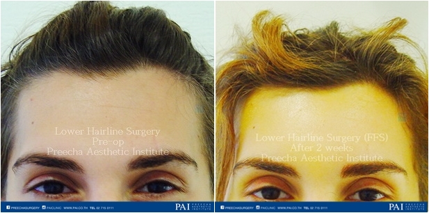 Lower Hairline Surgery facial feminization surgery (FFS) before and after surgery