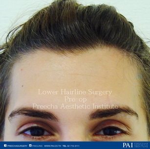 Lower Hairline Surgery facial feminization surgery (FFS) before surgery
