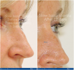 Nose hump shaving before and after 12 days surgery l preecha aesthetic institute