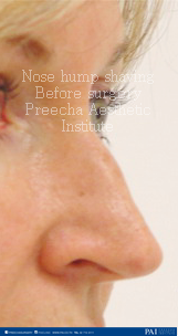 Nose hump shaving before surgery l preecha aesthetic institute
