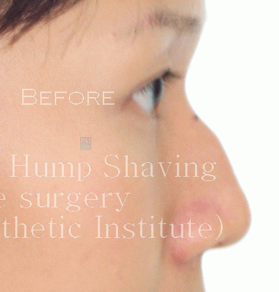 Nose hump shaving before surgery