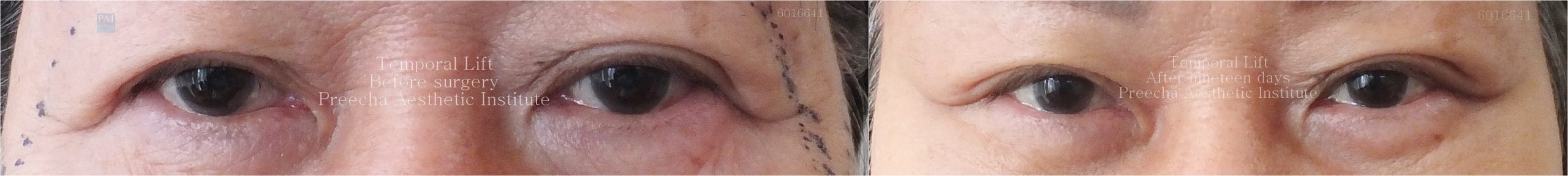 Temporal lift before and after 19 days surgery preecha aesthetic institute