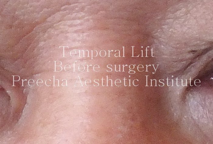 Temporal lift before surgery preecha aesthetic institute