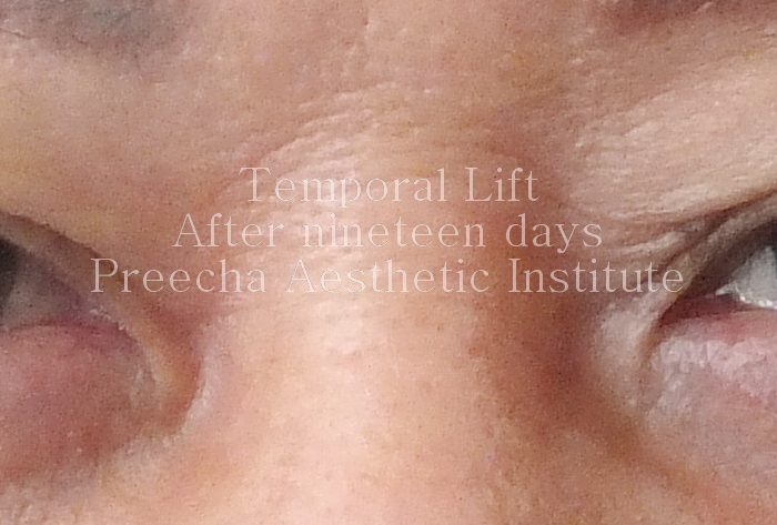 after 19 days temporal lift surgery by preecha aesthetic institute