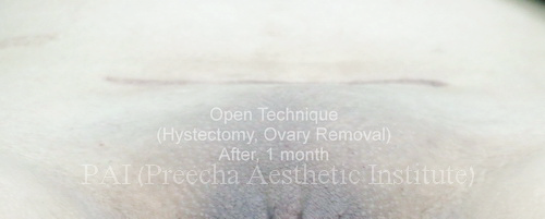 after Open Technique hysterectomy and ovary removal
