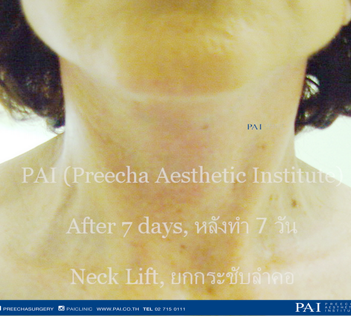 after neck lift l preecha surgery bangkok thailand