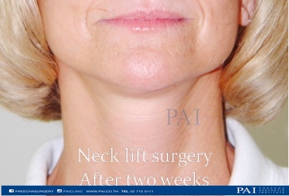 after two weeks neck lift preecha aesthetic institute