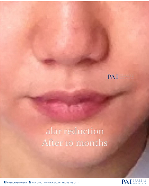 alar reduction after ten month preecha clinic thailand