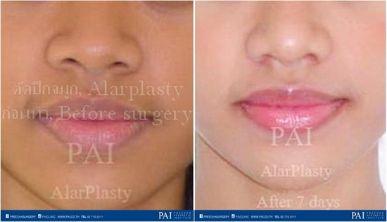 alar reduction alarplasty before surgery after