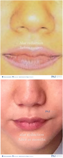 alar reduction before and after ten surgery preecha aesthetic institute