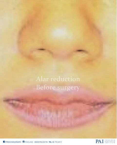 alar reduction before surgery preecha aesthetic institute