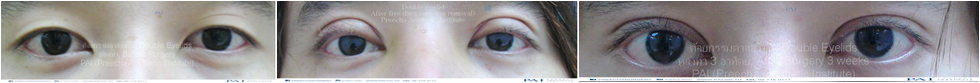 before and after 3 weeks double eyelid l preecha aesthetic institute