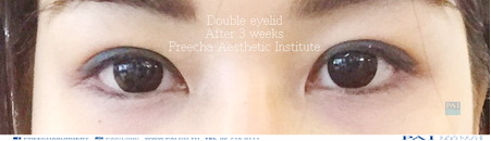 double eyelid after 3 weeks surgery l Preecha Aesthetic Institute