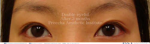 double eyelid after three months surgery l preecha aesthetic institute bangkok thailand