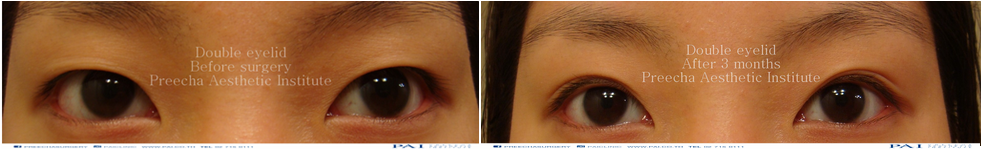 double eyelid before and after 3 month surgery l preecha aesthetic institute bangkok thailand