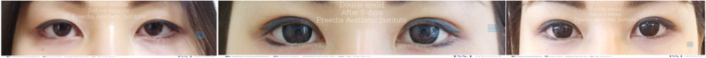 double eyelid before and after 3 weeks surgery l preecha aesthetic institute