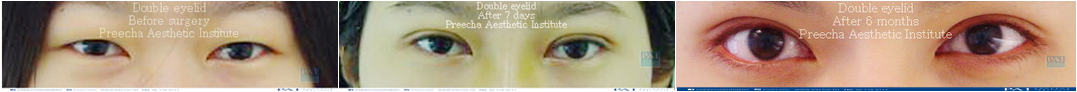 double eyelid before and after 6 months l Preecha Aesthetic Institute