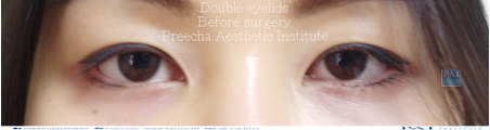 double eyelid before surgery l preecha aesthetic institute 1