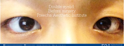 double eyelid before surgery l preecha aesthetic institute